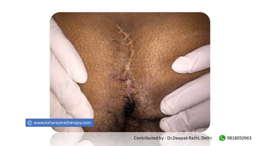 Pilonidal Sinus with Recurrence